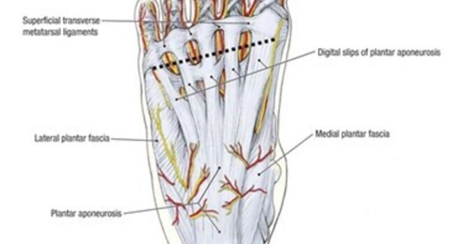Prevention of Plantar Fasciitis image